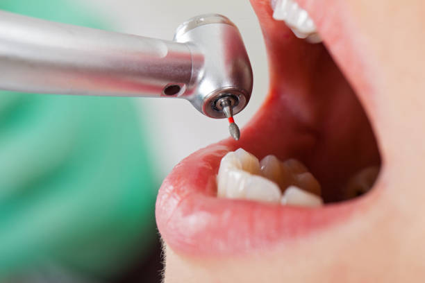 Best Emergency Root Canal Treatment in Olivarez, TX